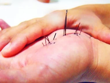 Τι να κάνετε αν πατήσετε αχινό, δράκαινα, τενεκεδάκι, γυαλί